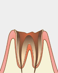 C4　歯が溶けて根本部分だけ残った状態