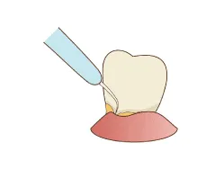 歯と歯の間に溜まった、 歯垢を除去します。